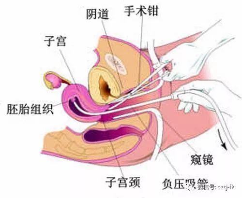 最新人工流产费用详解与科普知识介绍