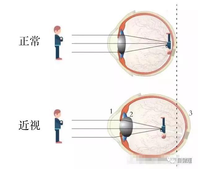 时代背景下的儿童视力健康新标杆，最新儿童眼轴标准发布