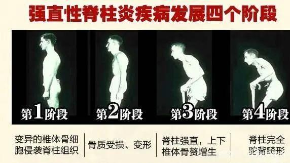 明星群体中的强直性脊柱炎，了解、关注与启示