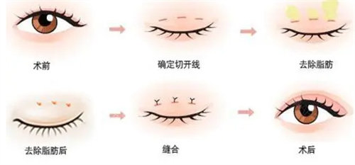最新双眼皮手术，技术革新与美容新潮的交融之美