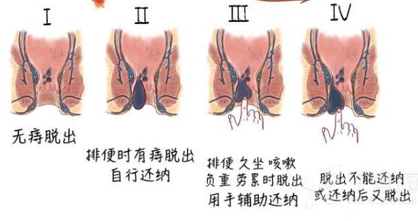 最新痔疮手术观点阐述与深度解析