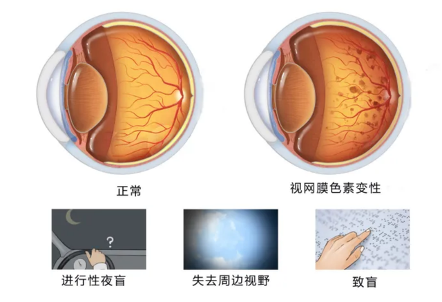 视网膜色素变性最新进展详解，步骤指南与最新突破
