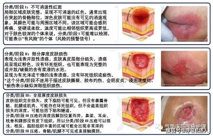 压疮分级的最新标准，了解、预防与应对策略